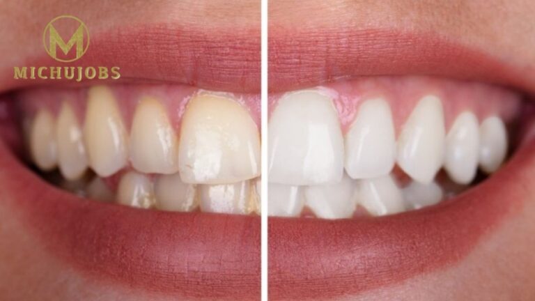 Teeth Whitening